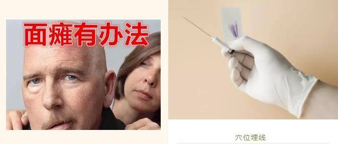 穴位埋线治疗面瘫
