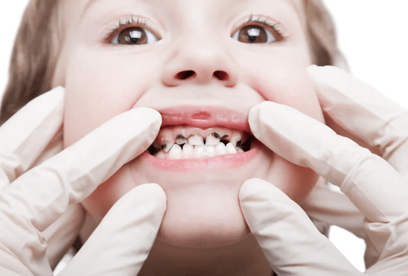 几个月开始涂氟 1bad67d9fea441d2b458d9b4321ec7ea.png