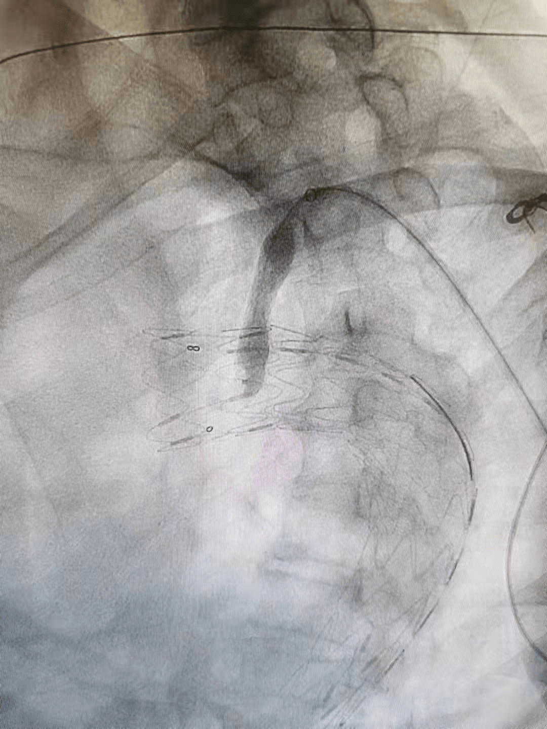 团队|罕见又危险！巨大溃疡长在主动脉上！人民医院专家团队通力合作让患者转危为安