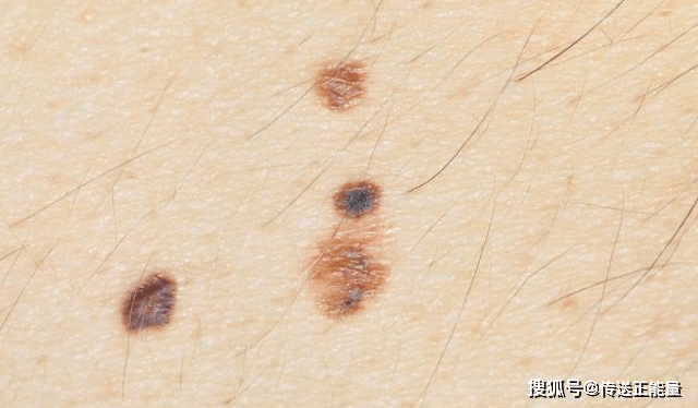 蜘蛛痣这种痣其实与血管瘤还是很相似的,蜘蛛痣的中间会出现一个红点