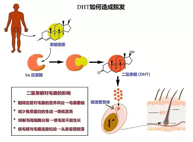 雄激素性脱发原理图片