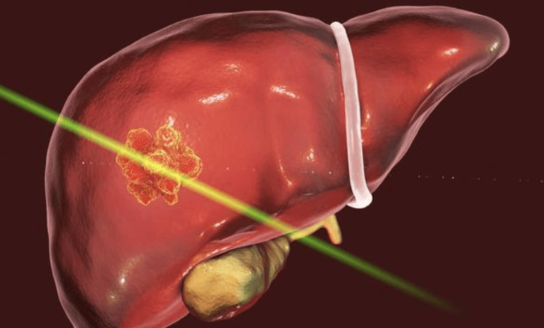 癌变|39岁男教师坚持早睡4年,肝硬化癌变离世,医生:晨起1习惯等于“自残”