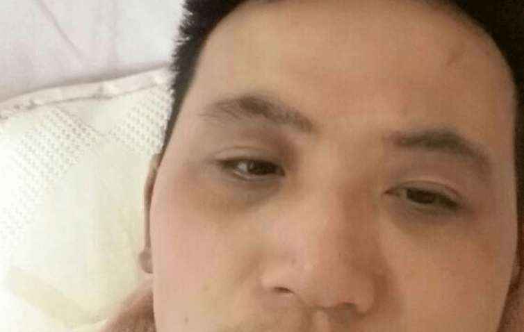刘杰|43岁农民工皮肤过敏,3个月后确诊肝癌,医生:皮肤3种异常,早做检查
