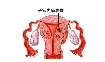 切口|每月来了大姨妈，剖宫产手术刀口肚皮就疼，留神子宫内膜症在做怪