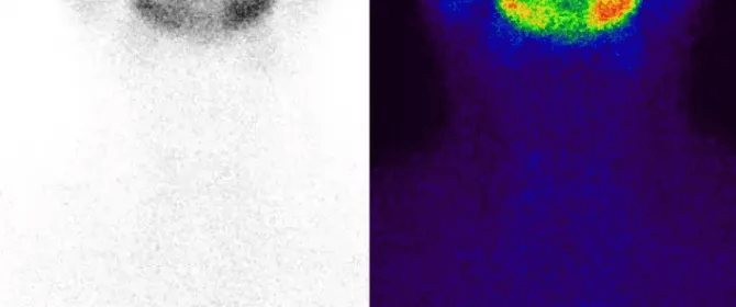 明显降低|季节更替感冒频发，当心 “亚甲炎”找上门！