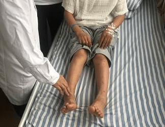 寄生虫|过敏性紫癜是怎么引起?