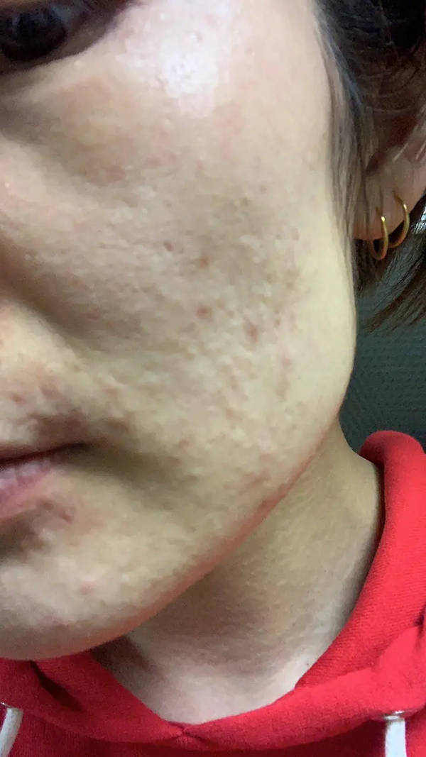 柠檬秦书雅的脸祛痘是真的吗，秦书雅的脸真的如说的那么好吗？