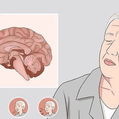 是一种|运动神经元病是怎么引起的?