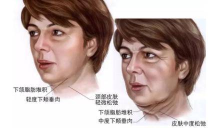 下巴来不及解释了，快上车，四招辅助“决战”双下巴