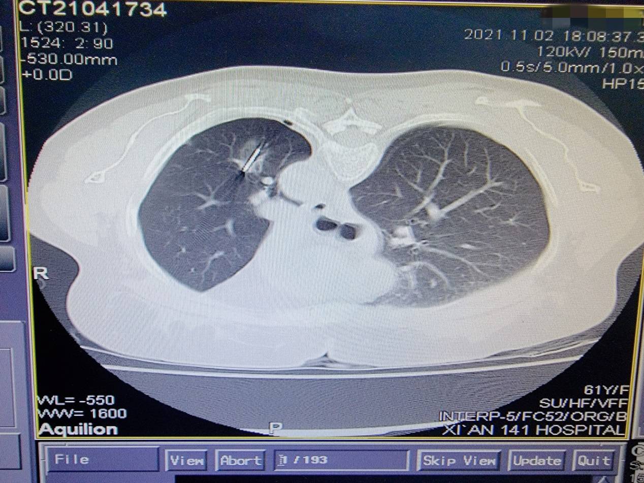肿瘤|西安交大一附院东院区胸外科成功开展东院首例肺结节微波消融术