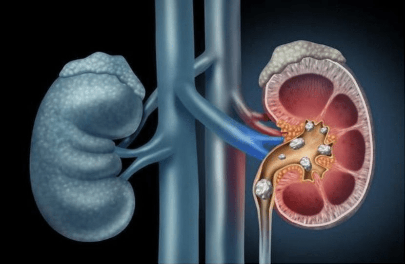 尿酸|小便是尿酸“警示器”!排尿时出现3种异常,尿酸恐已超“标准线”