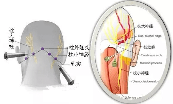 脑袋|头痛一定是头的问题吗？枕大神经痛，一种不容忽视的头痛！