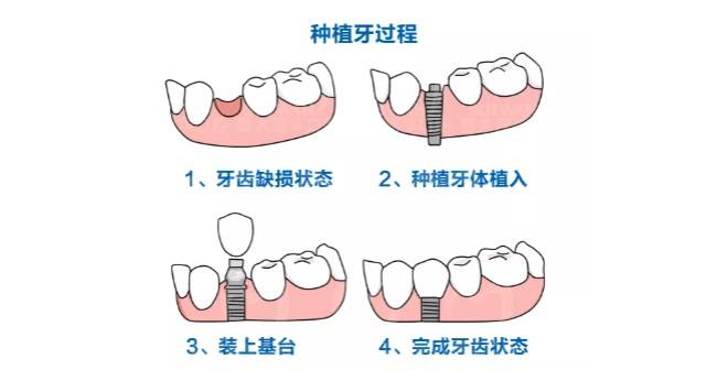 就能恢復半口牙,半口種植費用16000元起;活動假牙,普通材料4千左右