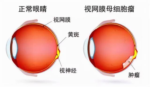 视网膜|咸阳市第一人民医院完成全市首例眼内恶性肿瘤摘除术