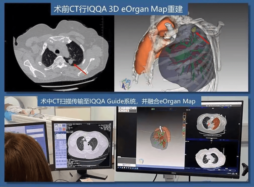 上圖:iqqa術前eorganmap三維重建及手術規劃上圖:iqqa03-guide術中