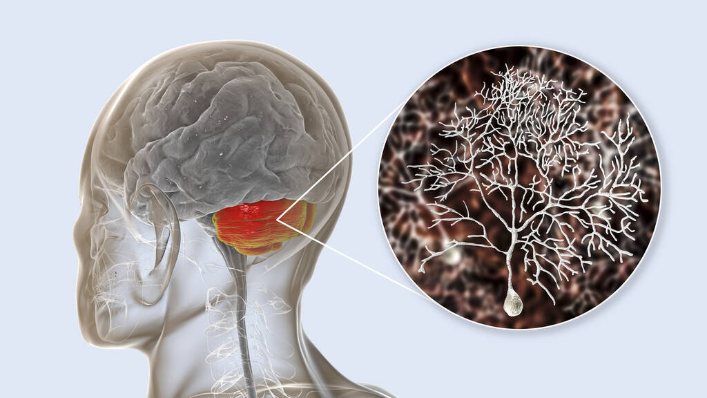 症状|百草养元汤：运动神经元病早期症状怎么治疗