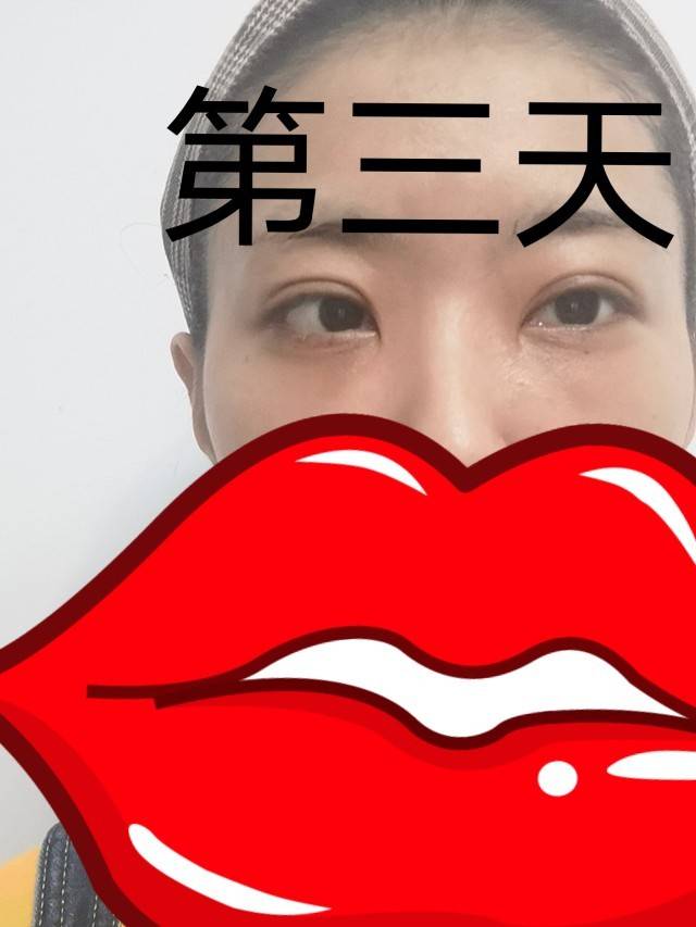 冰袋双眼皮术后护理小妙招