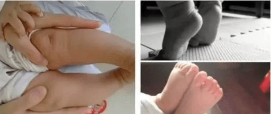 关节|【就诊指南】脑瘫患儿处于不同阶段，治疗方案也会有所调整