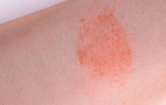 症状|糖尿病患者身体出现这6大症状，李爱国主任提醒可能是糖尿病肾病来了，别忽视!