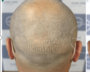 黑米3d纹发植发提取后枕部的毛囊会对取发区有影响吗
