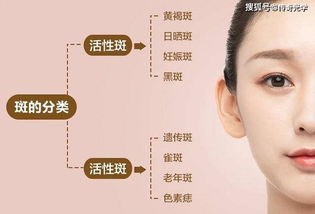 因为你不懂什么是雀斑_祛斑_面部_遗传性