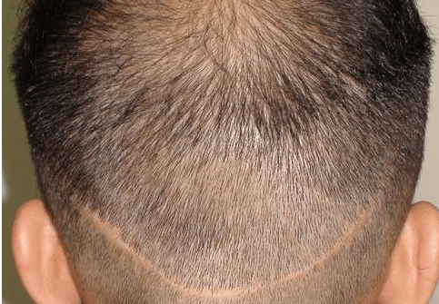 黑米3d纹发:植发提取后枕部的毛囊,会对取发区有影响吗?