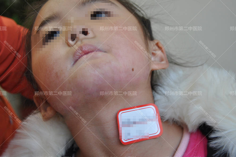 针对各类疤痕,目前采用综合性的治疗方式,通过超声离子束,5a焕肤仪