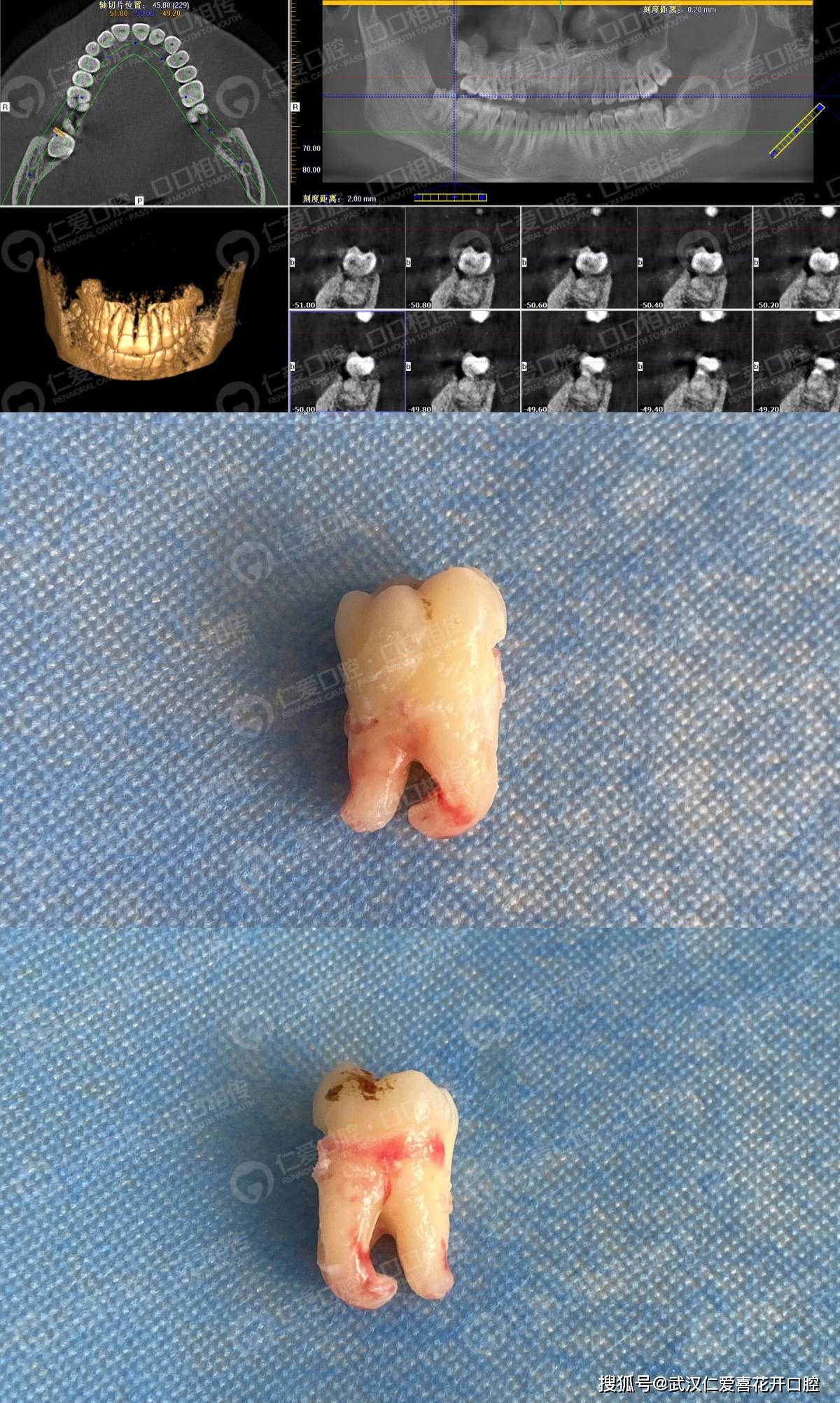 超声骨刀案例:因巧用"太极拔除法"的方式让患者摆脱痛苦受到点赞和