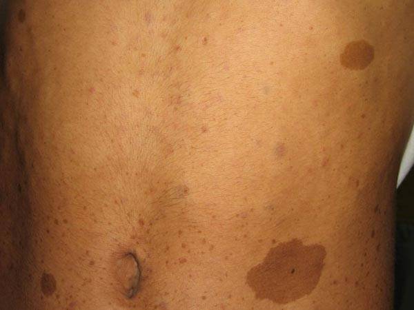 郑州市第二中医院:咖啡斑和神经纤维瘤有关联吗?_牛奶咖啡_影响_患者