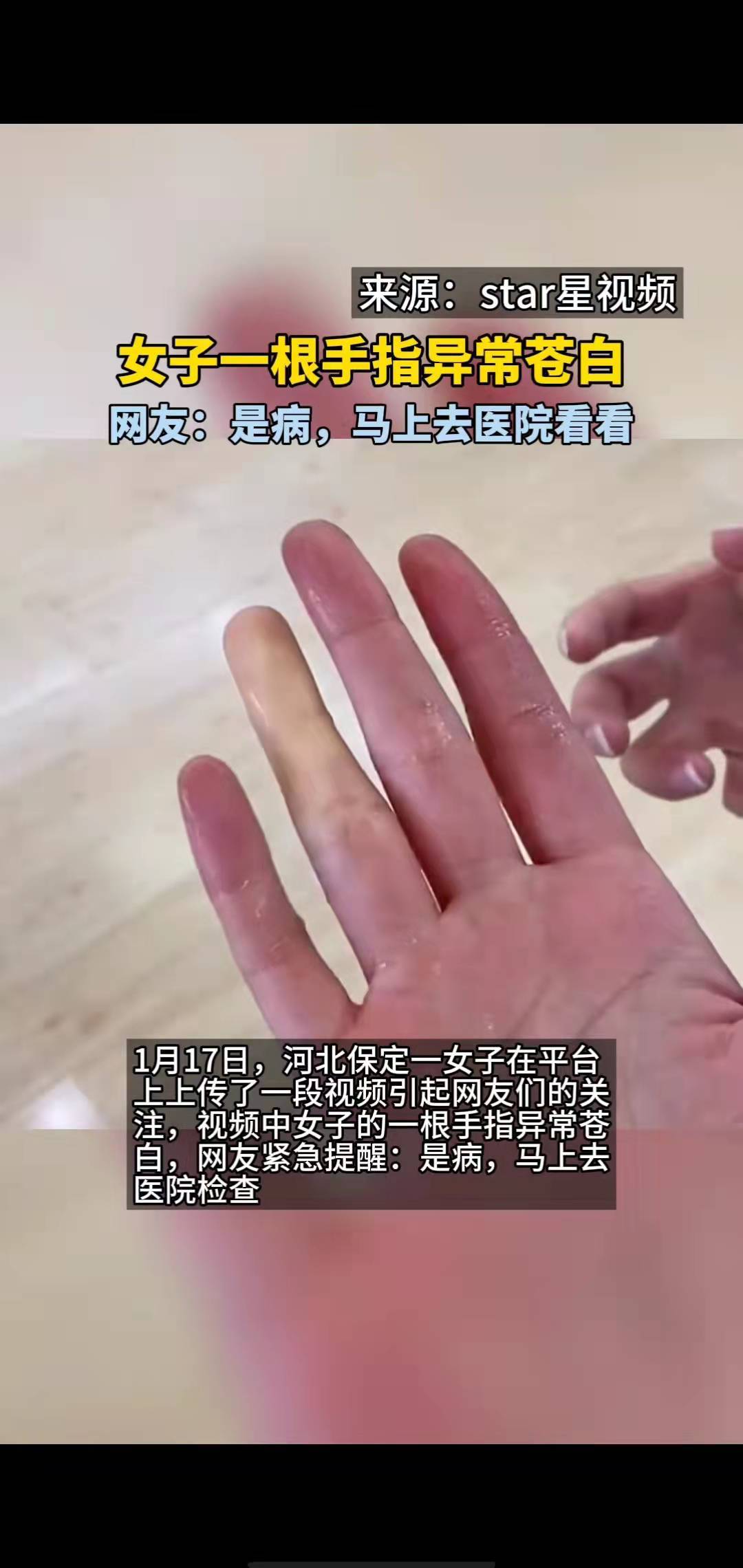 女子一根手指异常苍白,网友:是病。-搜狐大视野-搜狐新闻