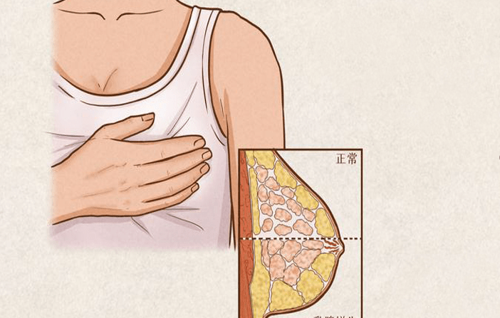一侧或者两侧乳房常有胀痛或刺痛感,日常情绪变化较大时乳房局部会有