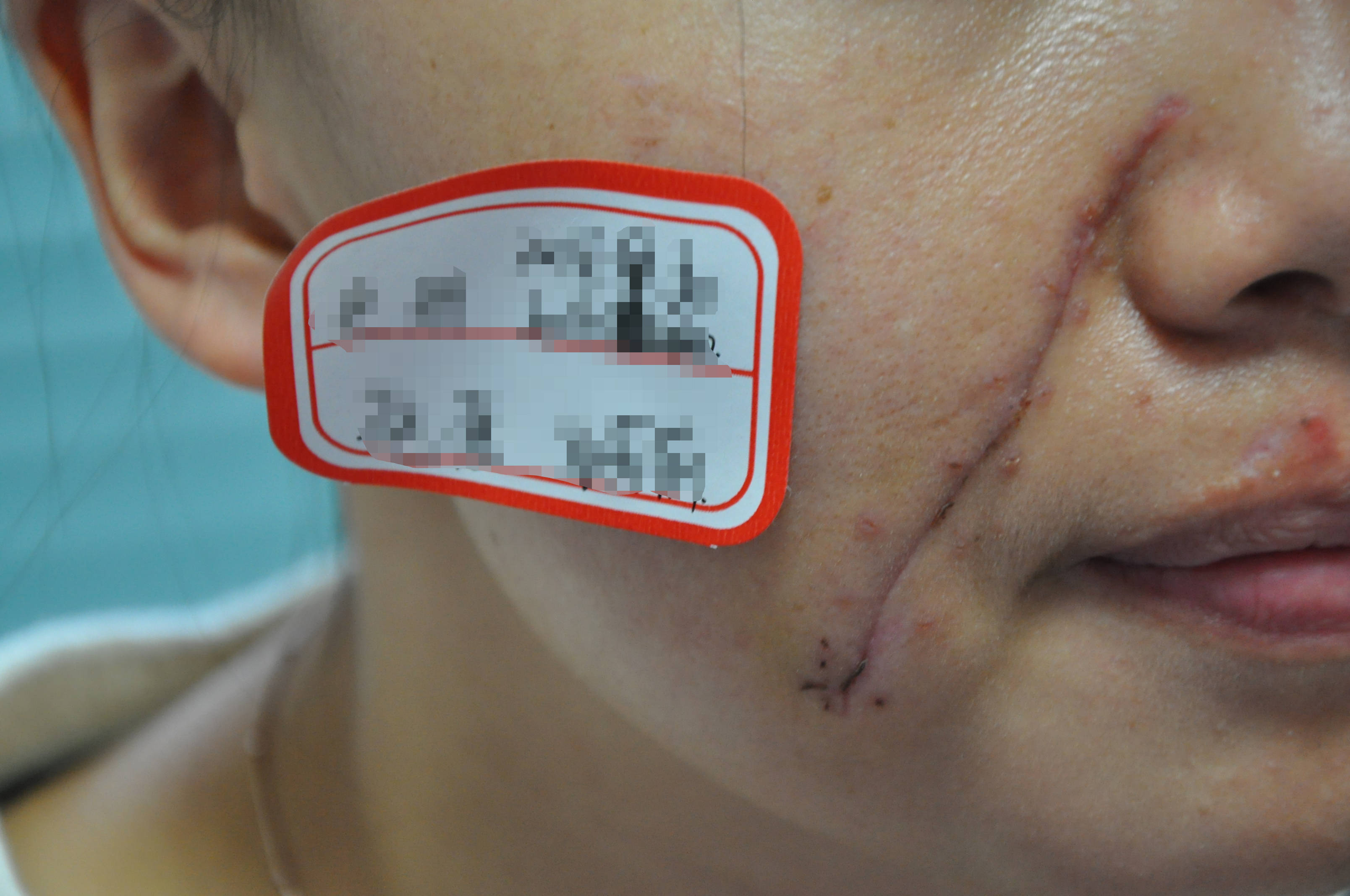 郑州市第二中医院医生科普脸上凹陷疤痕能去除吗