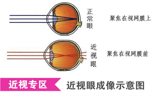 裸眼3d近视视力训练的原理