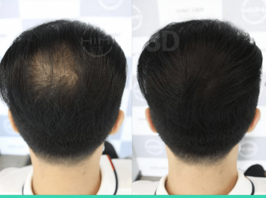 进行黑米3D纹发：头皮衰老常态化，对于头发生长可不是好兆头！