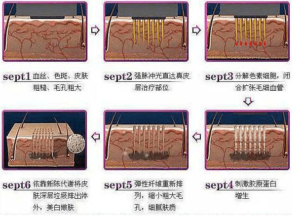 dpl光子嫩肤仪的效果怎么样？