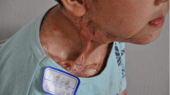 小孩疤痕修复_儿童_疗法_组织