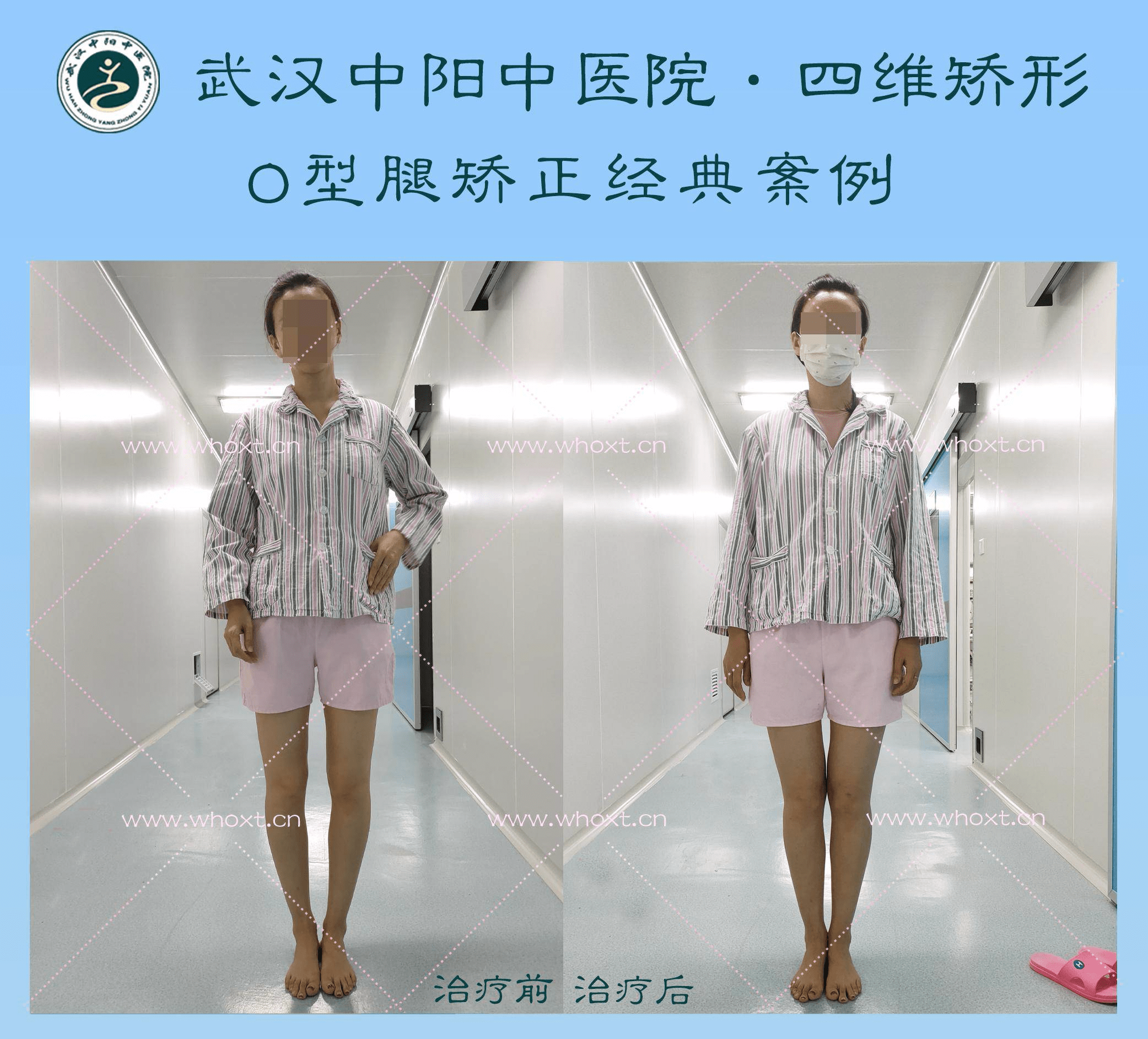 技术|O型腿怎样才算严重 武汉中阳中医院四维矫形技术专业矫正腿型异常