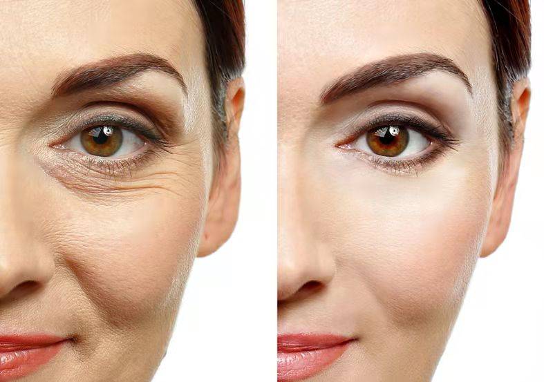 什么做线雕有什么好处,做线雕会不会有什么后遗症知道的聊聊~