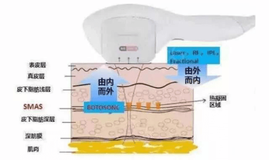 能量疑问：超声刀适合多大年龄的人做？超声刀美容能维持多久？