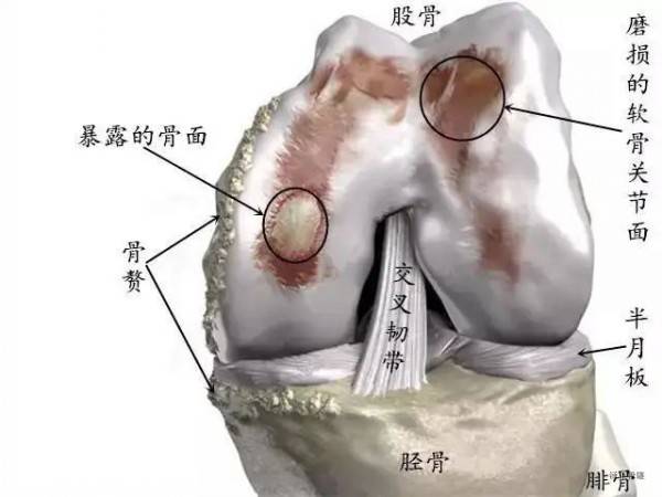 膝盖窝正常图片图片