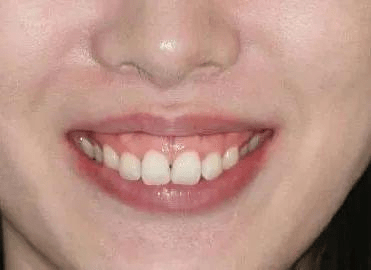 为什么有人一笑就露牙龈