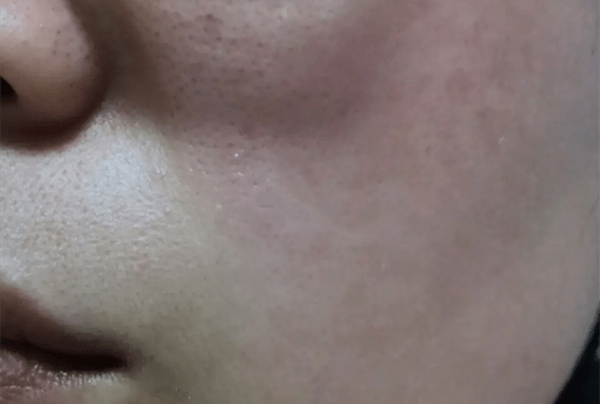 产品怎么判断是不是激素脸？80%的女生都不知道！