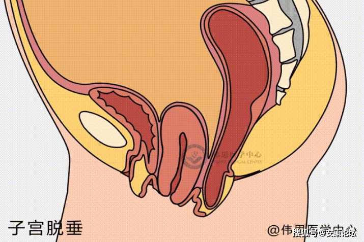 子宫外长肉粒是图片图片