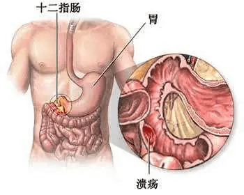 胃溃疡症状表现有哪些图片