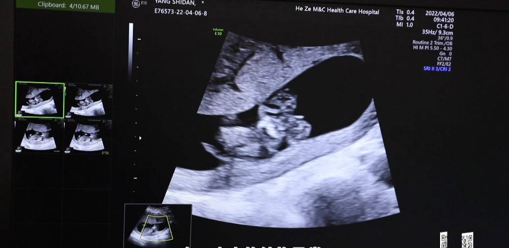 怀孕b超单图片 胎儿图片