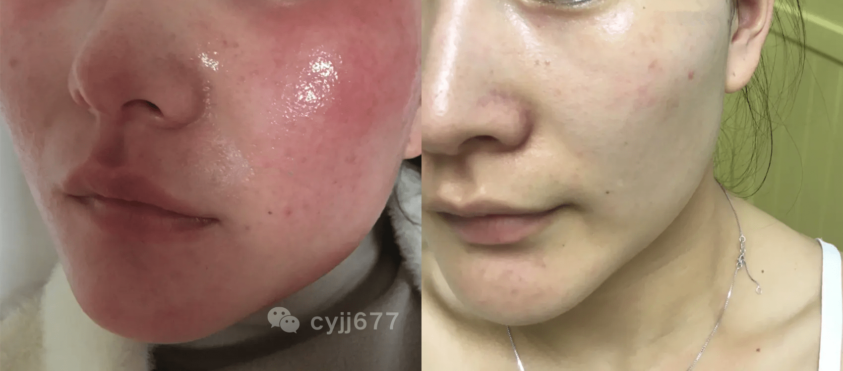 鸡皮肤能用夫西地酸(鸡皮肤用夫西地酸乳膏) 鸡皮肤能用夫西地酸(鸡皮肤用夫西地酸乳膏)