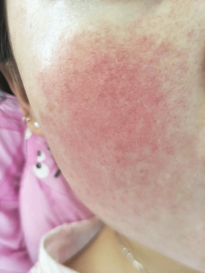 怎样确定自己敏感肌敏感肌要怎么恢复正常