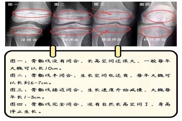 膝盖骨骺线对照表图片