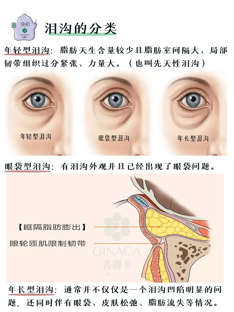 泪沟怎么才能消除?图片