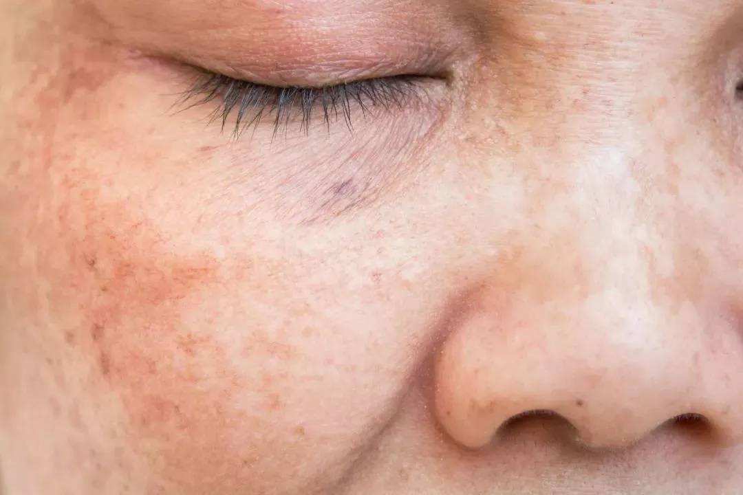 为什么有些人还没60岁,脸上就长了很多老年斑?_氧化_皮肤_微循环
